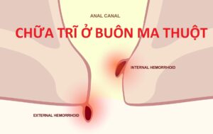 Chữa trĩ ở Buôn Ma Thuột