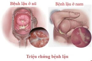 Chữa lậu ở Buôn Ma Thuột uy tín